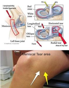 Human Body Anatomy, Knee Pain Relief, Medical Anatomy, Body Anatomy, Medical Knowledge, Knee Injury