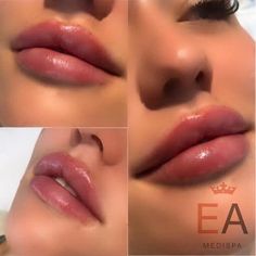 Ideal Lips, Elite Aesthetics, Lip Surgery, Model Beauty Secrets, Heart Shaped Lips, Lips Inspiration, Facial Fillers, Lip Filler, Facial Rejuvenation