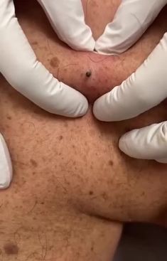 Benefits of Professional Pimple Extraction | #DermatologyClinic #SkinCareServices #BeautyConsultation #ClearFaceGoals #BeautyExperts Huge Blackheads, Pimple Extraction, Clear Blackheads, Pimples Under The Skin, Zit Popping Videos, Natural Acne Remedies, Clear Pores, Get Rid Of Blackheads, Natural Cough Remedies