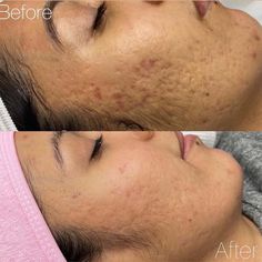 Acne Before And After, Microdermabrasion Before And After, Dermabrasion Before And After, Facial Cupping, Derma Pen, Skin Advice, Acne Scar, Skin Resurfacing, Essential Oils For Skin