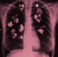 an x - ray shows the chest and lungs with small white flowers on it's side