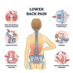 Lower back pain and painful body backbone skeleton causes outline diagram. Labeled educational scheme with explanation of medical condition after disease process or sitting posture vector illustration #Lower #back #pain #spine #backache #commercial #vector #illustration → Get this Illustration for Commercial Use! Lower Back Pain Poster, Low Back Pain Poster, Low Back Pain Exercise, Backbone Anatomy, Spine Illustration, Physio Therapy, Lower Back Pain Causes, Back Bone, Therapy Exercises