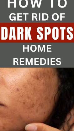 Clear Even Skin, Dark Spots Removal, Dark Spots Remedies, Dark Spots On Face, Brown Spots Removal, Brown Spots On Face, Lighten Dark Spots, Clear Complexion, Remove Dark Spots