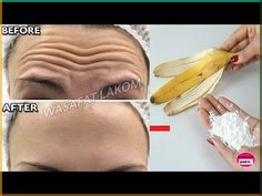 Even if you are 70 apply it and remove forehead wrinkles naturally quickly#foreheadwrinkles#removeforeheadwrinkles#removefinelinesandwrinkles#removewrinkles#... Remove Forehead Wrinkles, Deep Forehead Wrinkles, Home Remedies For Wrinkles, Diy Wrinkles, Natural Remedies For Migraines, Wrinkle Remedies, Dry Skin Remedies, Forehead Wrinkles, Skin Detox