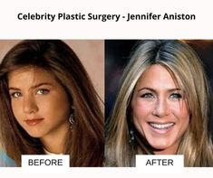 Celebrity Plastic Surgery: 31 Before And After Images Ariana Grande Plastic Surgery, Kardashian Plastic Surgery, Kylie Jenner Plastic Surgery, Botched Plastic Surgery, Celebrity Surgery, Nose Jobs, Plastic Surgery Gone Wrong, Plastic Surgery Procedures, Odd Things