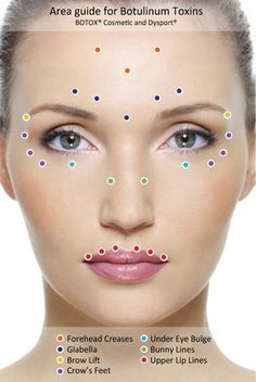 Botox Injection Sites, Injection Sites, Facial Injections, Botox Injection, Botox Brow Lift, Aesthetic Dermatology, Botox Cosmetic, Botox Face, Facial Fillers