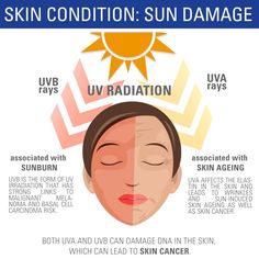 Sun damage caused by the sun & sunscreens Sunburn Skin, Sun Damaged Skin, Natural Organic Skincare, Wrinkled Skin, Sensitive Teeth, Sun Damage, New Skin