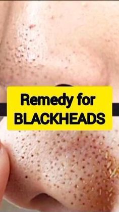 How To Remove Discoloration On Face Home Remedy For Blackheads, Remedy For Blackheads, Nose Pimples, For Blackheads, Blackhead Remedies, Mekap Mata, Blackheads On Nose, Losing 40 Pounds