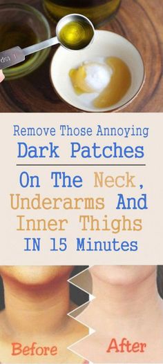 Dark Patches On Skin, Listerine Mouthwash, Skin Brightener, Squat Motivation, Pain Relief Patches, Side Fat, Bloated Stomach, Tighten Skin, Effective Exercises