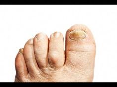 Foot fungus is when—well, toenail fungus is when the nail gets injured, and fungal material invades the nail and makes it thickened, unsightly, sometimes mal... Toenail Fungus Essential Oils, Wine Making Kits, Toenail Fungus Remedies, Skin Cream Anti Aging