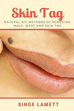 Remove Moles, Skin Tags, Skin Natural Remedies, Natural Health Care, Natural Sleep Remedies