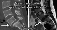 an x - ray shows the location of myelinia and meerding grade 1 spondyllithises of l5 on 5 on s1