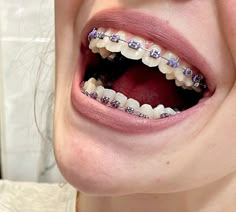 Aesthetic Teeth, Dental Braces Colors, Braces Colors Combinations, Pink Braces, Braces Bands, Ceramic Braces, Braces Cost, Pretty Teeth