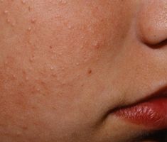 Tiny,bumps, aka chicken skin rash (keratosis pilaris) occur on arms,cheeks & thighs.Is it a gluten rash? Are chicken skin & gluten connected? Reduce Face Redness, Redness On Face, Rash On Face, Rid Of Blackheads, Retinoic Acid, Keratosis Pilaris, Bumpy Skin, Chicken Skin, Get Rid Of Blackheads