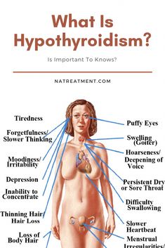 What is hypothyroidism is one kind of disease because the lowest of thyroid hormone. You will get hypothyroidism cause some of the causes. Hashimotos Symptoms, Thyroid Diet Plan, Thyroid Hair, Epstein Barr, Gallbladder Diet, Lichen Planus, Body Board, Deficiency Symptoms