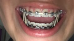 Braces Problems, Simple Cartoon Characters, Black Braces, Cute Braces Colors, Teeth Aesthetic, Pretty Teeth, Adult Braces, Glossy Lips Makeup, Braces Tips