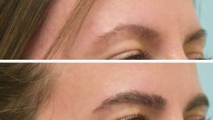 Dallas Eyebrow Transplant HD Closeup Video Eyebrows And Eyelashes, Fuller Eyebrows, Hair Transplant Procedure, Tattoo Shading, Fue Hair Transplant, Hair Due, Thick Eyebrows