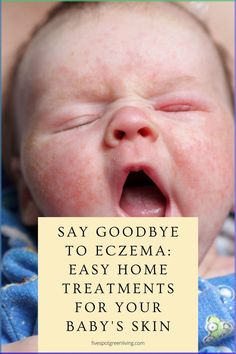 Say goodbye to your baby's uncomfortable eczema with these simple at-home treatments! Foods For Healthy Skin, Beauty Oil, Sensitive Skin Care, Itchy Skin, Love Tips, Oils For Skin, Baby Skin