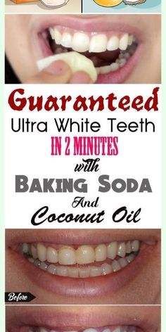 Must try this hack for teeth whitening within 2 minutes Reverse Receding Gums, White Teeth Diy, Benefits Of Coconut Oil, Oil Pulling, Healthy Beauty