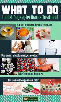 What to Do the First Days After Braces Treatment - Infographic - Braces Edina - The Edina Orthodontics Blog #braces #orthodontics #orthodontist How To Prepare For Braces, Things You Can’t Eat With Braces, Braces Meme, After Braces, Braces Memes Humor, Misaligned Teeth