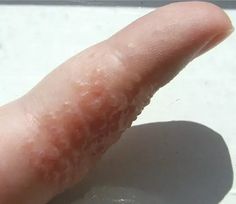 I cured my pompholyx, a disfiguring,  itchy and painful skin condition affecting the hands and feet. Heart Diet, Skin Condition, Skin Conditions, Conditioner, Diet, Skin