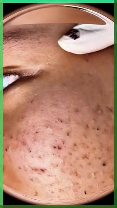 5 Natural Scrubs to Remove Blackheads Effectively
#naturalscrubs #blackheadsolutions #clearskinhacks #DIYskincare #porecleaning Skin Care Myths, Steaming Your Face, Healthy Face, Pimples On Face, Facial Steaming, Remove Blackheads