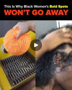 Alopecia Hair Growth, Herbs For Hair Growth, Clean Blackheads, Funky Short Hair, French Skincare, Hair Treatments, Clearer Skin, Hair Remedies, Hair Follicle