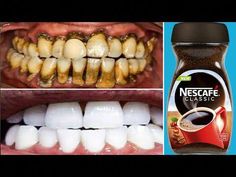 Teeth Whitening In 1 Minute Remove Yellowing And Tartar Falls After Rubbing Your Teeth With ItI hope this video will be helpful to you. Don’t forget to share... Hot Nail Designs, Loose Tooth, Lip Care Routine, Yellow Teeth, Cold Symptoms, Health And Fitness Magazine, Natural Teeth, Make Life Easier