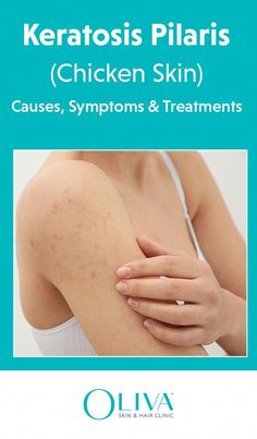 What is keratosis pilaris? Read this article to know the complete information about keratosis pilaris treatment, causes, diet plans and tips. Acne On Arms How To Get Rid Of, Kerotisis Pilaris, How To Get Rid Of Bumps On Arms, Acne On Arms, Skin Bumps On Arms, Arm Pimples, Cheek Acne Cause, Bumps On Skin, Cheek Pimples