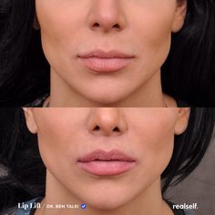 Upper Lip Lift, Face Proportions, Fat Grafting, Fuller Lips, Lip Augmentation, Injectables Fillers, Botox Fillers