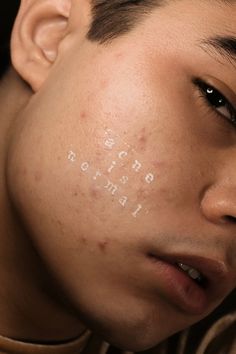 Different Types Of Acne, Real Bodies, Glow Skin, Foto Art, Beauty Standards, Body Love, Perfectly Imperfect, Body Image, Skin Conditions