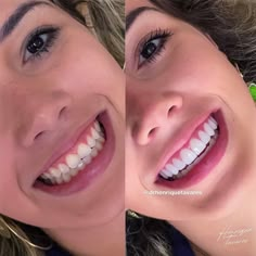 Perfect Smile Teeth Women, Cosmetic Dentistry Veneers, Fuller Lips Naturally, Cosmetic Dentistry Procedures, Skin Tightening Treatments