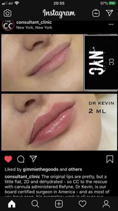 1 Ml Lip Filler Before And After, Lip Filler Natural, Aesthetic Nurse Injector, Nose Surgery Rhinoplasty, Facial Injections, Celebrity Surgery, Derma Fillers