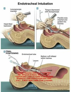 an image of the endocal inflibation and how it is done