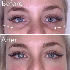 Tear Trough Filler, Dark Under Eye Circles, Bags Under Eyes, Sunken Eyes, Under Eye Circles, Under Eye Makeup