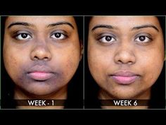 Natural Remedies For Pigmentation Faces, How To Get Rid Of Pigmentation Around Mouth, How To Get Rid Of Pigmentation On Face, Neck Pigmentation, Hyperpigmentation Around Mouth, Dark Skin Around Mouth, Diy Face Pack