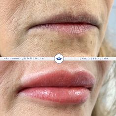 a woman's lips before and after her lip filler treatment at the clinic