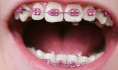 Pink Braces Hot Pink Braces Teeth, Braces Hot Pink, Braces Colours, Tracy Ross, Braces Ideas