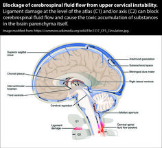 Burning Mouth, Concussion Symptoms, Cervical Instability, Glossopharyngeal Nerve, Concussions Recovery, Spinal Cord Stimulator, Symptoms Of Concussion, Post Concussion Syndrome, The Vagus Nerve