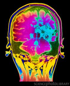 an mri scan shows the brain and it's areas, including the top part of the head