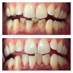 Cavity Remedy, Perfect Smile Teeth, Grow Back Receding Gums, Mobile Clinic, Whiten Teeth Fast, Tooth Infection, Tartar Removal, Tooth Decay Remedies, Heal Cavities