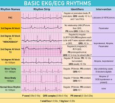 ECG reference guide are essential tools in clinical practice, providing healthcare professionals with a quick, standardized, and accurate method for interpreting electrocardiograms, thereby facilitating prompt diagnosis, improving patient outcomes, and ensuring adherence to best practices in cardiac care. Ekg Cheat Sheet, Ekg Interpretation Cheat Sheet, Ekg Interpretation Made Easy, Respiratory Therapist Student, Ekg Interpretation, Ecg Interpretation, Note Taking Tips, Medical Posters