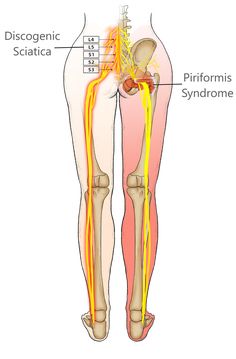 How To Relieve sciatica pain & Piriformis syndrome Exercise For Sciatic Nerve Pain, Piriformis Syndrome Symptoms, Sciatic Nerve Exercises, Spinal Degeneration, Nurse Skills, Piriformis Syndrome, Sciatica Pain Relief