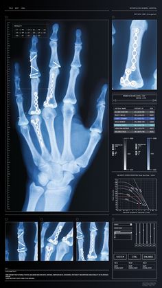 an x - ray image of a hand and wrist with the bones visible in it