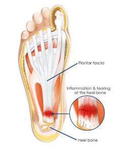 Facitis Plantar, Plantar Fascitis, Family Chiropractic, Running Injuries, Mommy Workout, Photo Blog