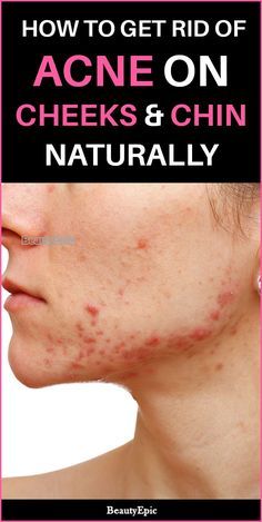 Acne On Cheeks, Chin Acne Causes, Cheek Acne, Warts On Face, Chest Acne, Face Mapping Acne, Forehead Acne, Get Rid Of Acne