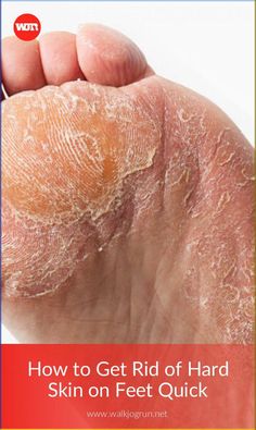 If you're struggling with hard skin on feet, we know the most effective DIY ways to get rid of hard skin on feet quick! Peeling Skin On Feet How To Get Rid Of, How To Get Rid Of Dry Skin On Feet Heels, How To Get Dry Skin Off Feet, Dry Feet How To Get Rid Of, Peeling Feet Remedy Diy, Dry Calloused Feet Remedy, How To Get Rid Of Dry Feet Skin, Rough Feet How To Get Rid Of, How To Get Smooth Feet At Home