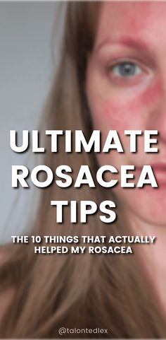 After 17 years of rosacea, these are the top 10 things that actually helped. Rosacea advice, rosacea treatment, rosacea tips. Roscea Help, Sensitive Skincare, Pimples Remedies, Pimples On Face, Acne Skincare, Get Rid Of Acne, Rid Of Acne, Inflammatory Diet, How To Get Rid Of Pimples