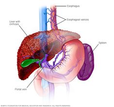 Esophageal Varices, Lung Cleanse, Reflux Disease, Medical Journals, Health Management, Chronic Inflammation, Mayo Clinic, Critical Care