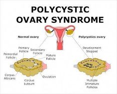 Negative Pregnancy Test, Polycystic Ovarian Syndrome, Polycystic Ovaries, Pregnancy Signs, Pregnancy Test, Hormone Imbalance, Amino Acid, Autoimmune Disease, Podcast